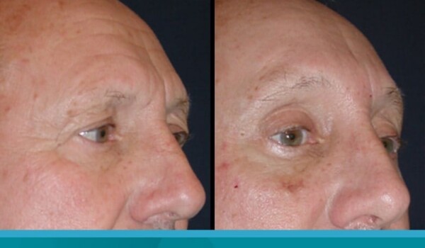 laser blepharoplasty