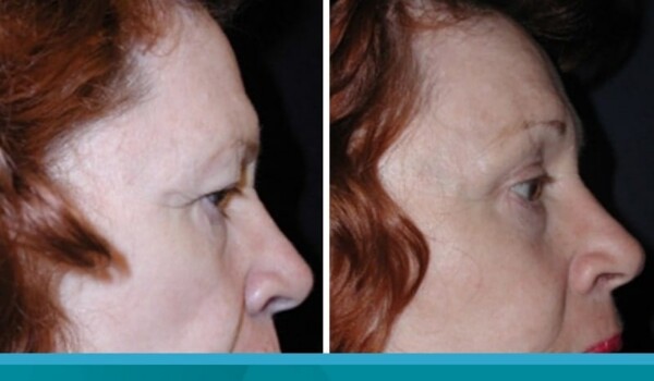 blepharoplasty buenos aires