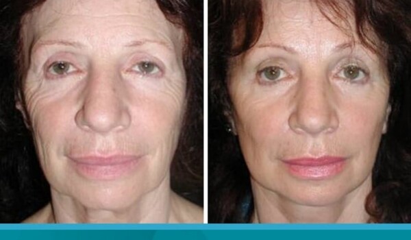 laser eyelid surgery