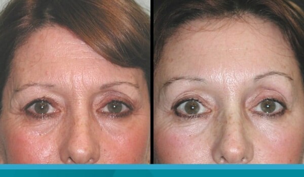 blepharoplasty