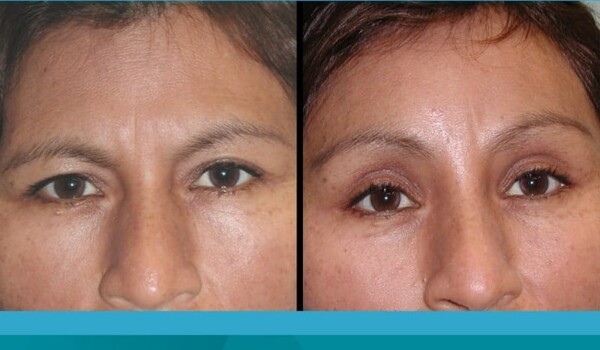 laser blepharoplasty