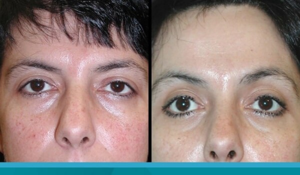 eyelid surgery in buenos aires