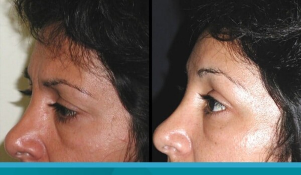 blepharoplasty without surgery argentina
