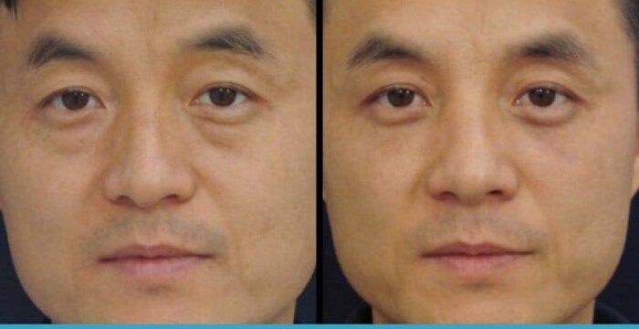 Asian eyelid surgery