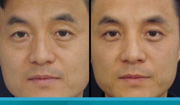 Asian eyelid surgery
