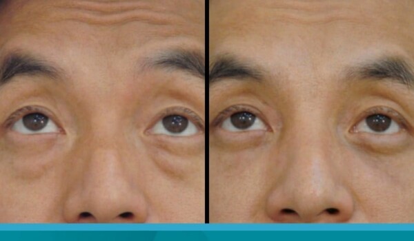 asian blepharoplasty