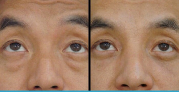 asian blepharoplasty