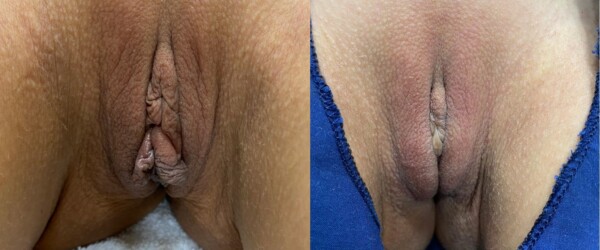 labiaplasty-9-4146781