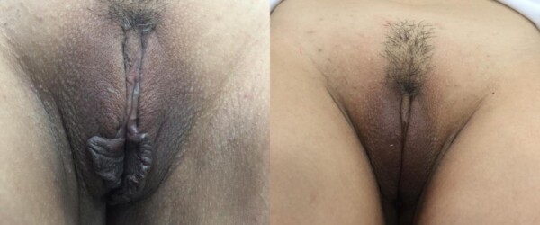labiaplastie au laser