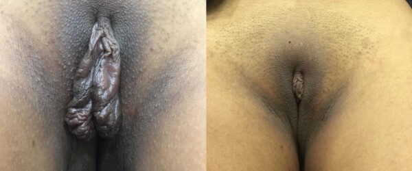 labiaplastie au laser