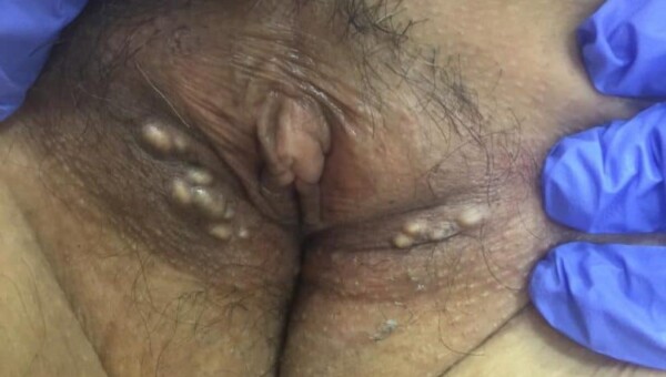 quistes vaginales