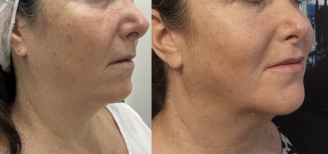 Paciente destacada en un evento educativo: capturas tomadas 30 días después de recibir 3 horas continuas de ULCHETERAPIA, complementadas con la aplicación de toxina botulínica y rellenos faciales. whatsapp-image-2023-10-23-at-20-19-40-8170349
