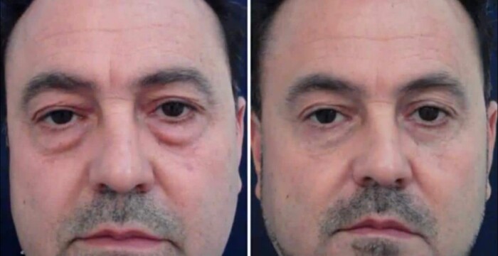 recovery eyelid surgery