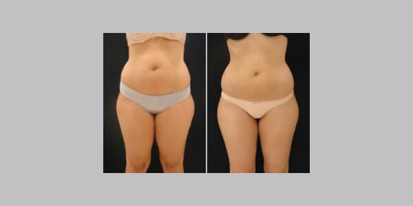 ilipo-antes-y-despues-01-300x204-6927769