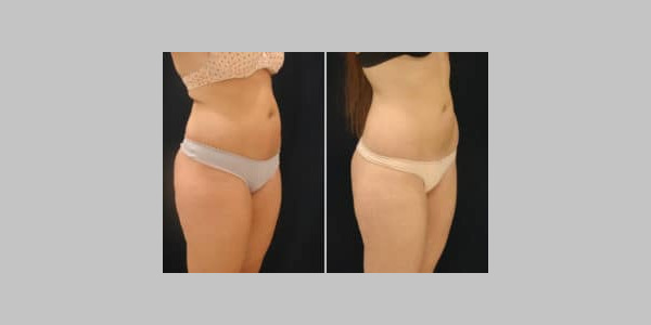 ilipo-antes-y-despues-02-300x204-9672523