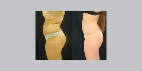 ilipo-antes-y-despues-03-300x204-2830227