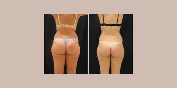 ilipo-antes-y-despues-04-300x204-3412672