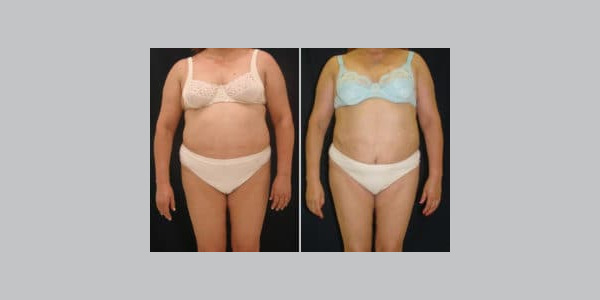 ilipo-antes-y-despues-06-300x204-8823569