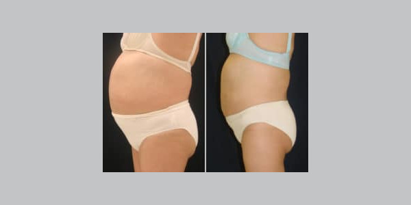 ilipo-antes-y-despues-07-300x204-3787305