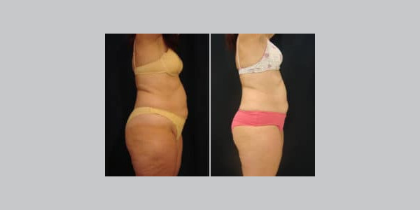 ilipo-antes-y-despues-09-300x204-3379611