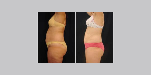 ilipo-antes-y-despues-10-300x204-6415934