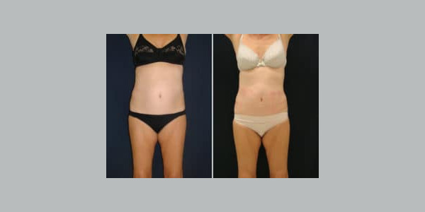ilipo-antes-y-despues-13-300x204-4283695