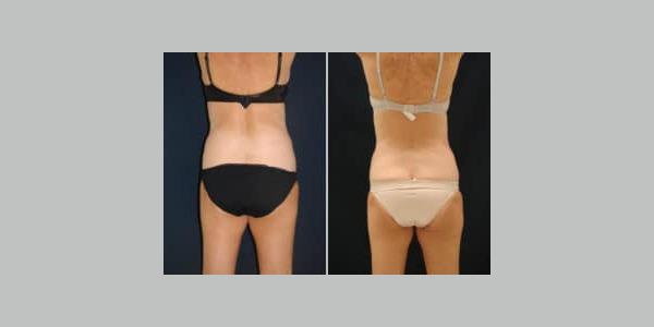 ilipo-antes-y-despues-15-300x204-7124523