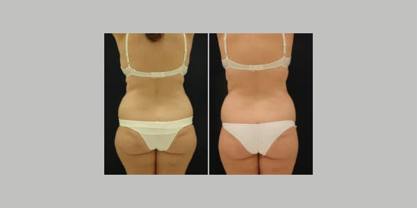 ilipo-antes-y-despues-25-300x204-6333206