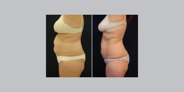ilipo-antes-y-despues-27-300x204-8314201