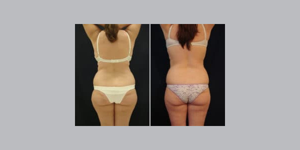 ilipo-antes-y-despues-28-300x204-9083855