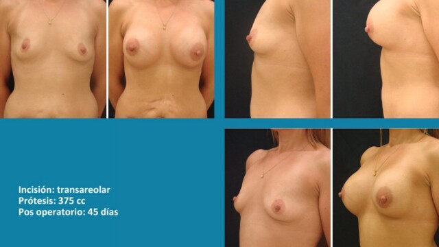 galeria-protesis-1512-01-1-1779924