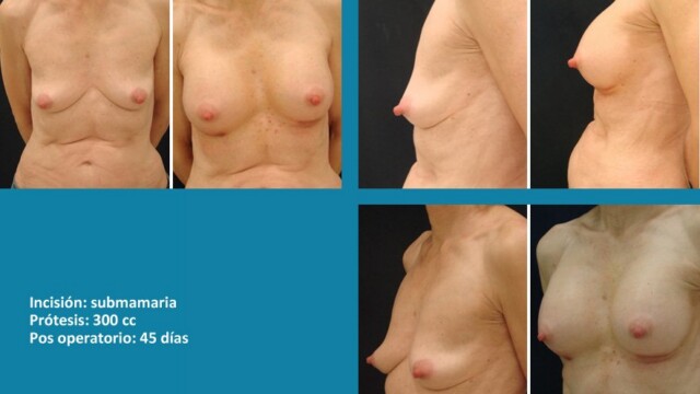 galeria-protesis-1512-02-1-1323887
