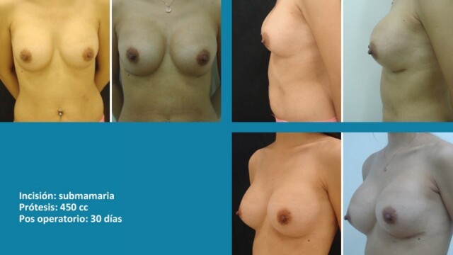 galeria-protesis-1512-04-1-9184391