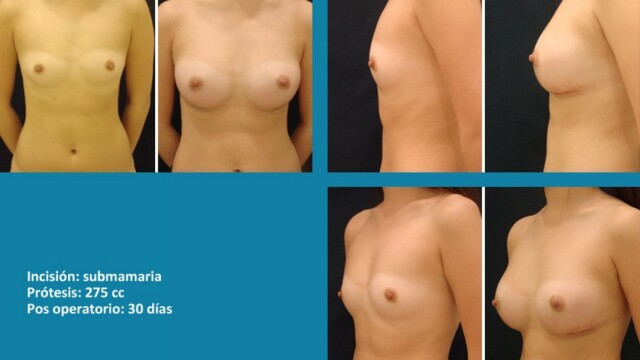 galeria-protesis-1512-07-1-4079806