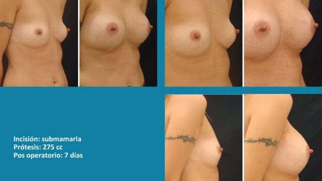 protesis02-2-9134192