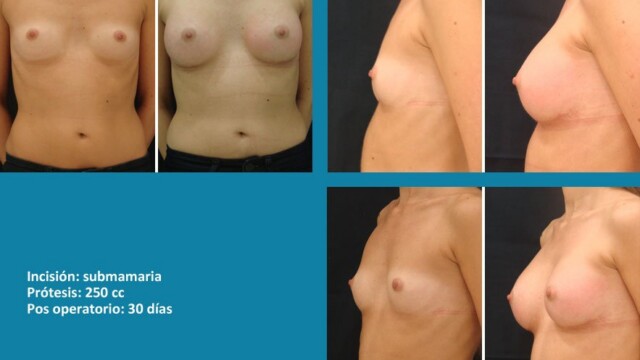 protesis04-2-7508722