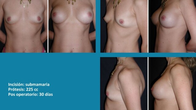 protesis05-2-6337946