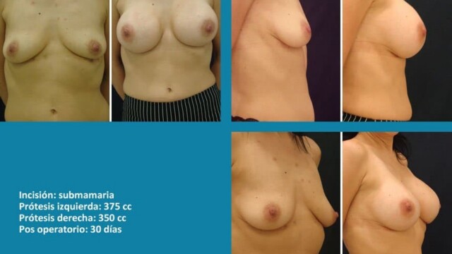 protesis06-2-7823520