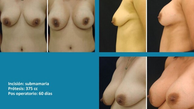 protesis07-1-5355088