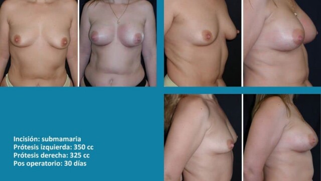 protesis08-1-3983414