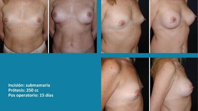 protesis10-1-9391097