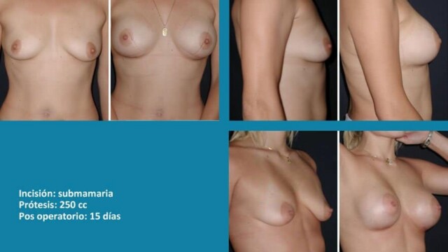 protesis11-1-9378025
