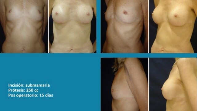 protesis12-1-9600590