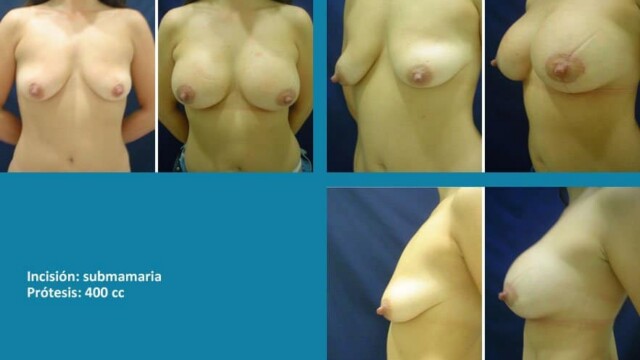 protesis13-1-6409358