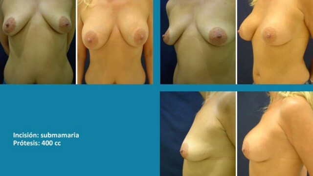 protesis14-1-7658180