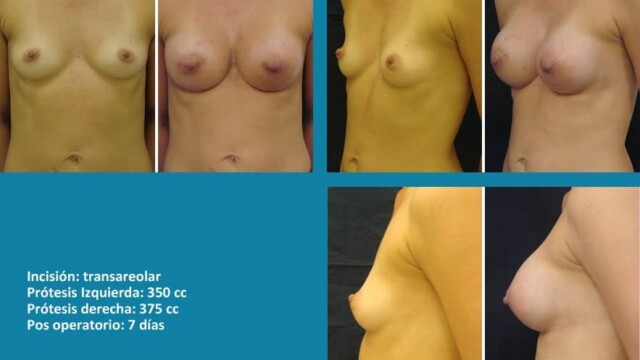 protesis16-1-6868725