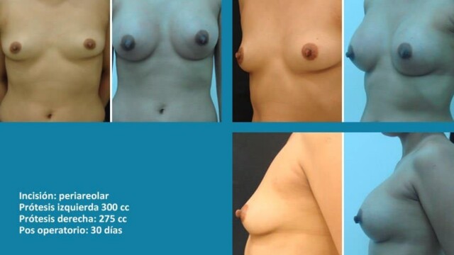 protesis18-1-1185638