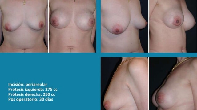 protesis21-1-7768818