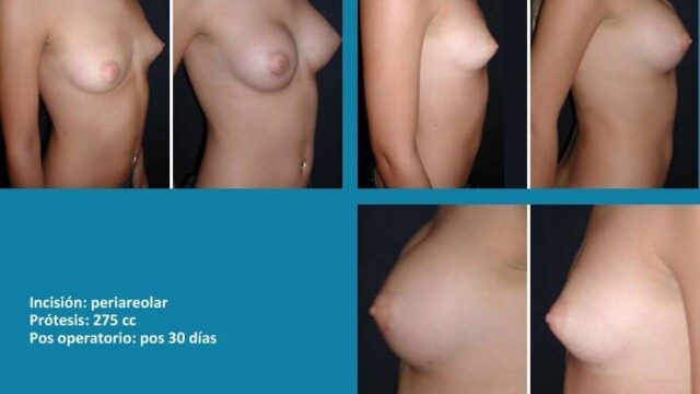 protesis22-1-5387262