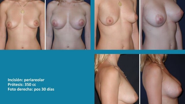 protesis23-1-6158022